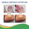Jaysuing Toenail Furrow Correction, Toenail Insert Nail Repair Correction Pull-up Nail Nail Patch