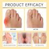 Ximonth Bee Venom Care Cream, Bee Venom Care Cream To Relieve Inflammation, Pain Swelling Can Improve Joint Health Bunions Adjuvant Therapy