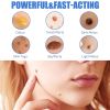 South Moon Warts Remover Cream, Verruca Filariform Smooth Verruca Verruca Flesh Grain Neck Face Armpit Skin Repair Cream
